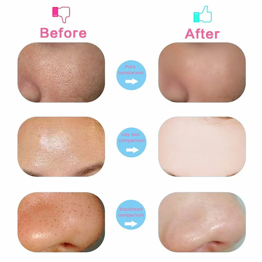 5-in-1 Electric Facial Cleanser & Massager | Blackhead Remover & Beauty Care Brush - Image 4